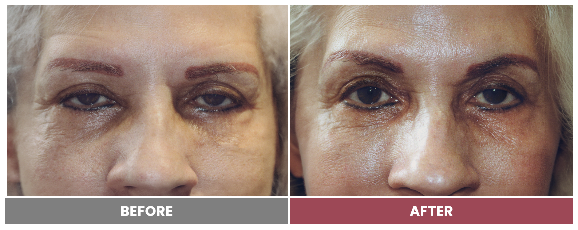 PTOSIS REPAIR - Case 60